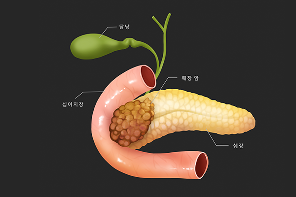 췌장암 이미지