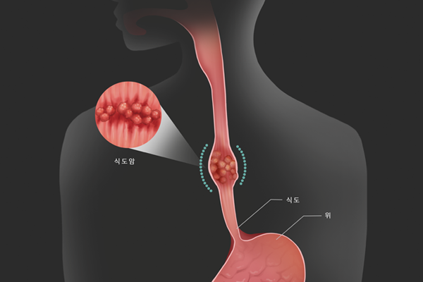 식도암 이미지