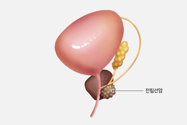 전립선암